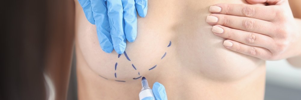Cirugía Oncoplástica del Seno