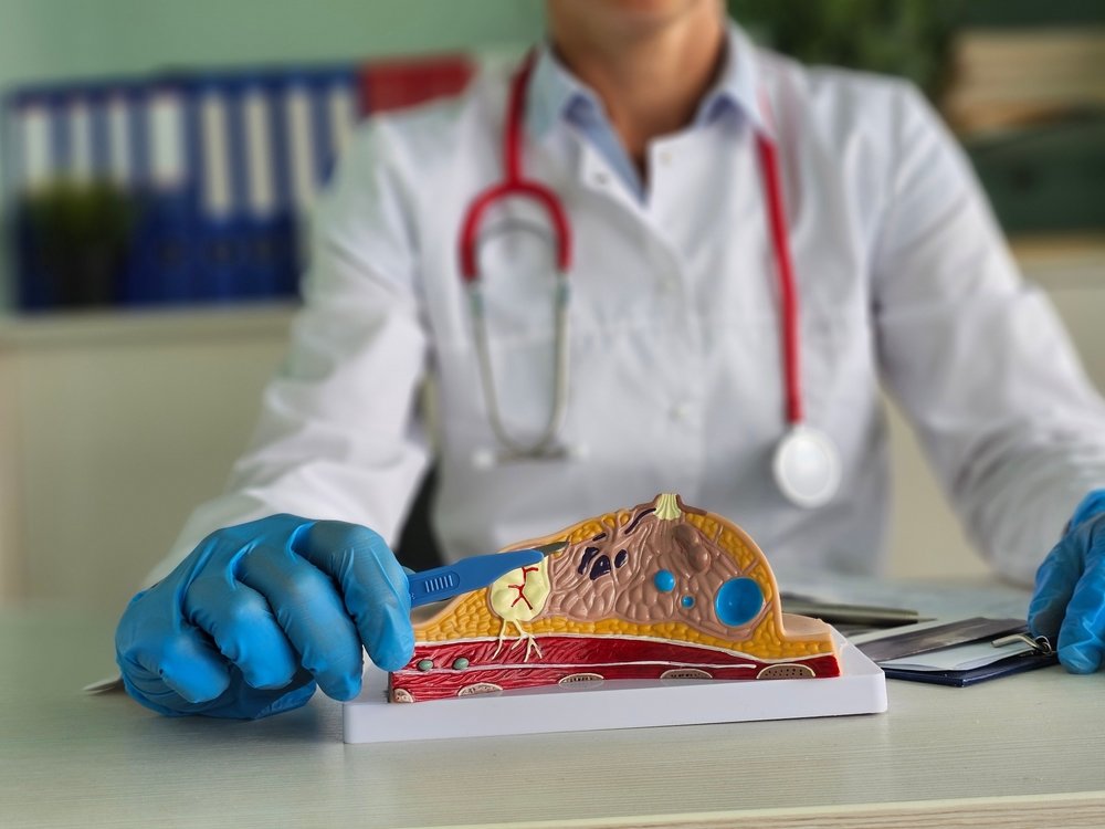 Extirpación de Tumor de Mama
