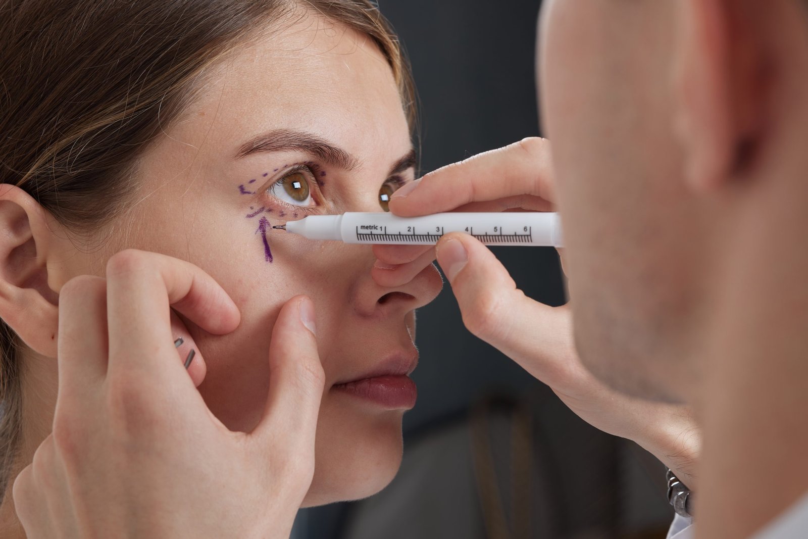 Blefaroplastia Parpados Inferiores