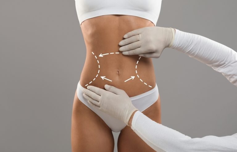Abdominoplastia: ¿Qué es? y beneficios