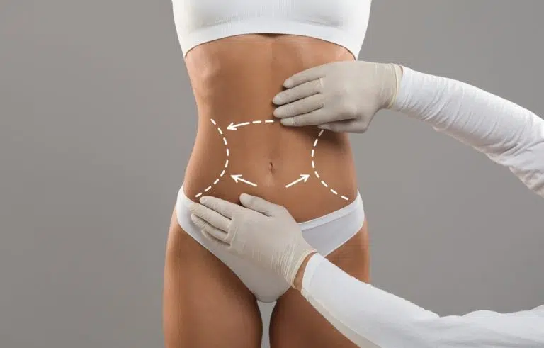 Abdominoplastia: ¿Qué es? y beneficios